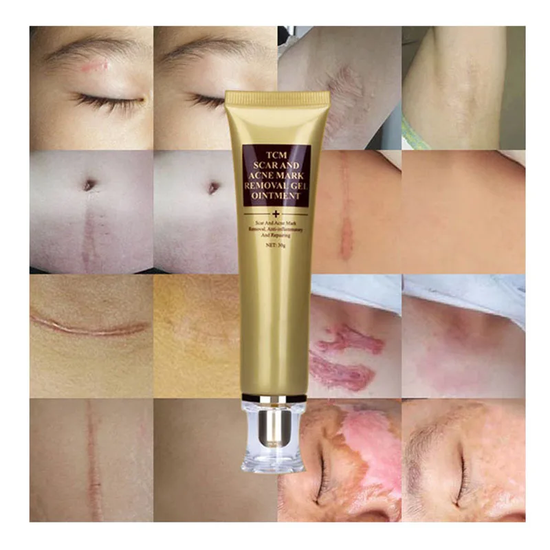 tcm scar and acne