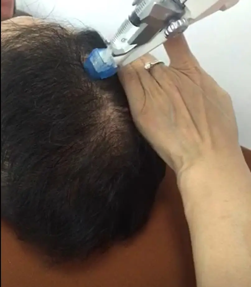 注入到真皮的头皮通过 meso 枪,真皮笔,真皮滚筒或注射器对头发的生长