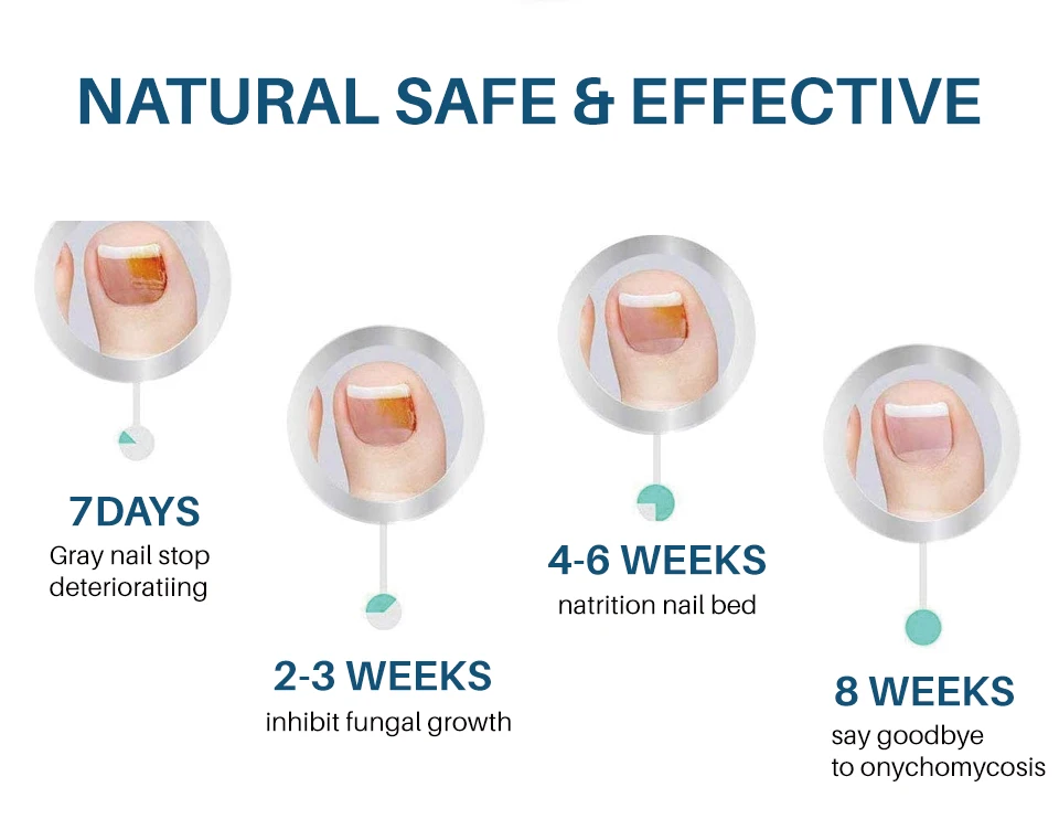 Lanthome 10ml Nail Repair Solution Clean Whiten Nourish Nails Fungal