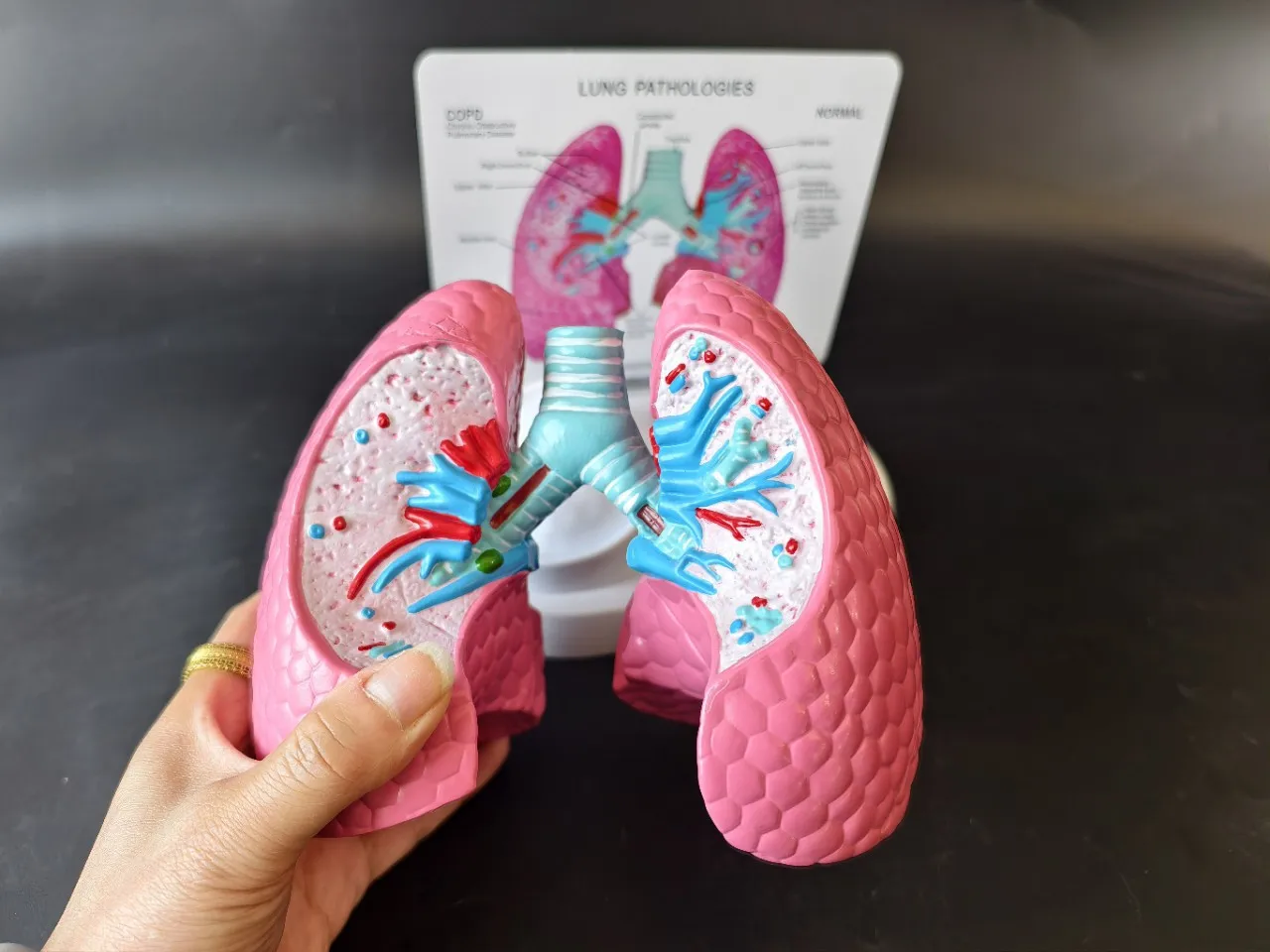 Anatomical Smoking Lung Health Model Respiratory Bronchial Teaching Aid ...