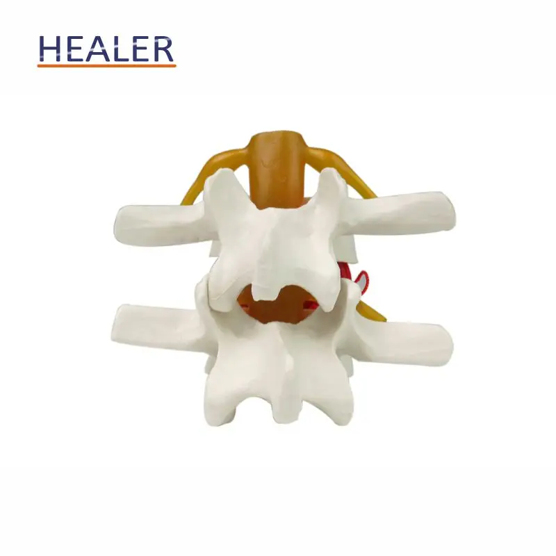 Lumbar Disc Herniation Demonstration Spine Model Plastic PVC Spinal ...