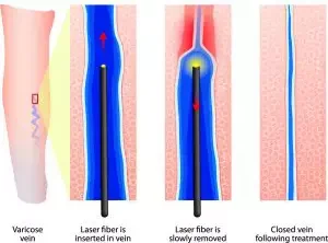2023 Beijing Starlight 1470nm 980nm diode laser Endolifting Liposuction Laser Fat loss device