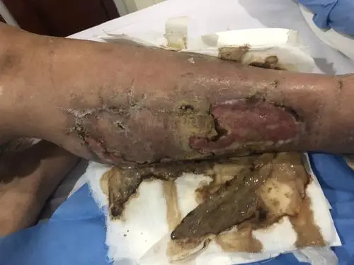 医用银海藻酸钙伤口敷料海藻酸钙绳