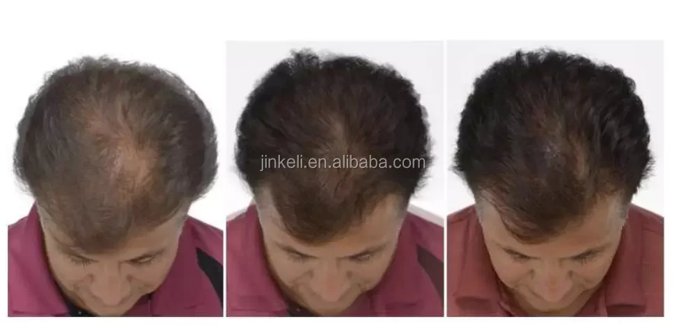 diode laser hair regrowth.png