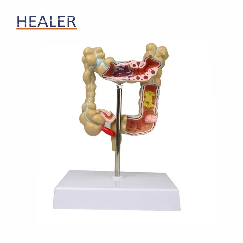Human Pathological Colon Model - Advanced PVC Anatomical Teaching Tool