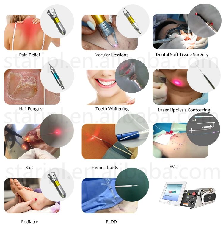 2023 Beijing Starlight 1470nm 980nm diode laser Endolifting Liposuction Laser Fat loss device