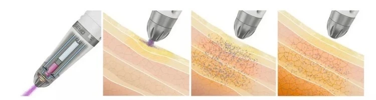 Korea Needle Free Skin Nutrient Water Ultrasonic Serum Dermaheal Mesotherapy Gun Machine