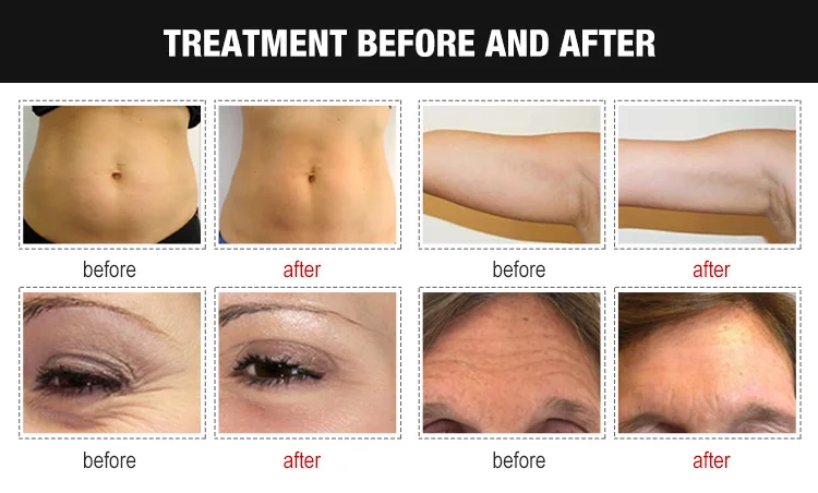 cavitation machine (3).jpg