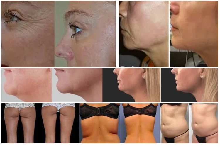 Professional 2 in 1 RF Radio Frequency Skin Tightening Equipment Body Slimming Machine