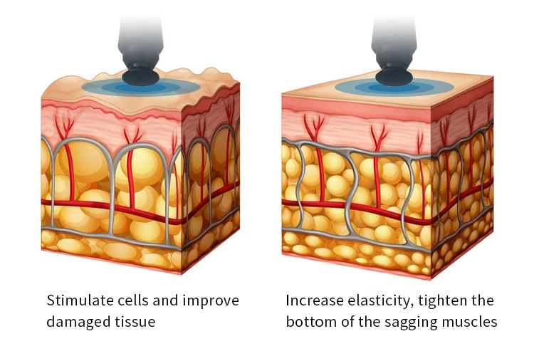 Factory RF Radio Frequency Ice Sculpture Machine Facial lifting Wrinkle Remover Cooling Shrink Pores Face Care beauty Equipment