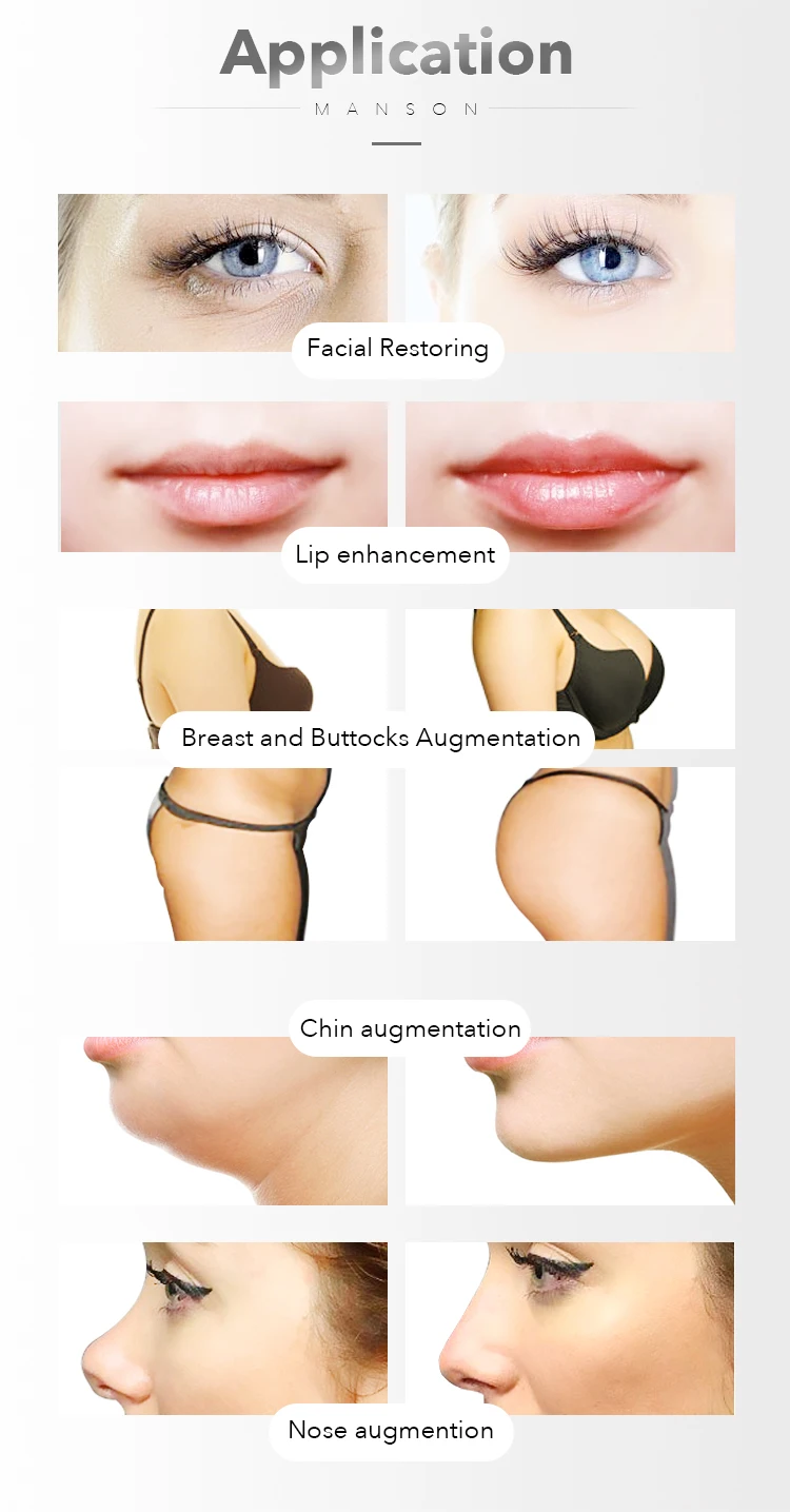 HA Derma filler (7)