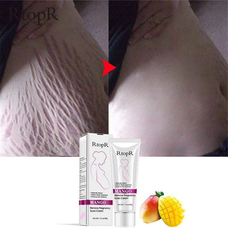 stretch marks cream (4).jpg
