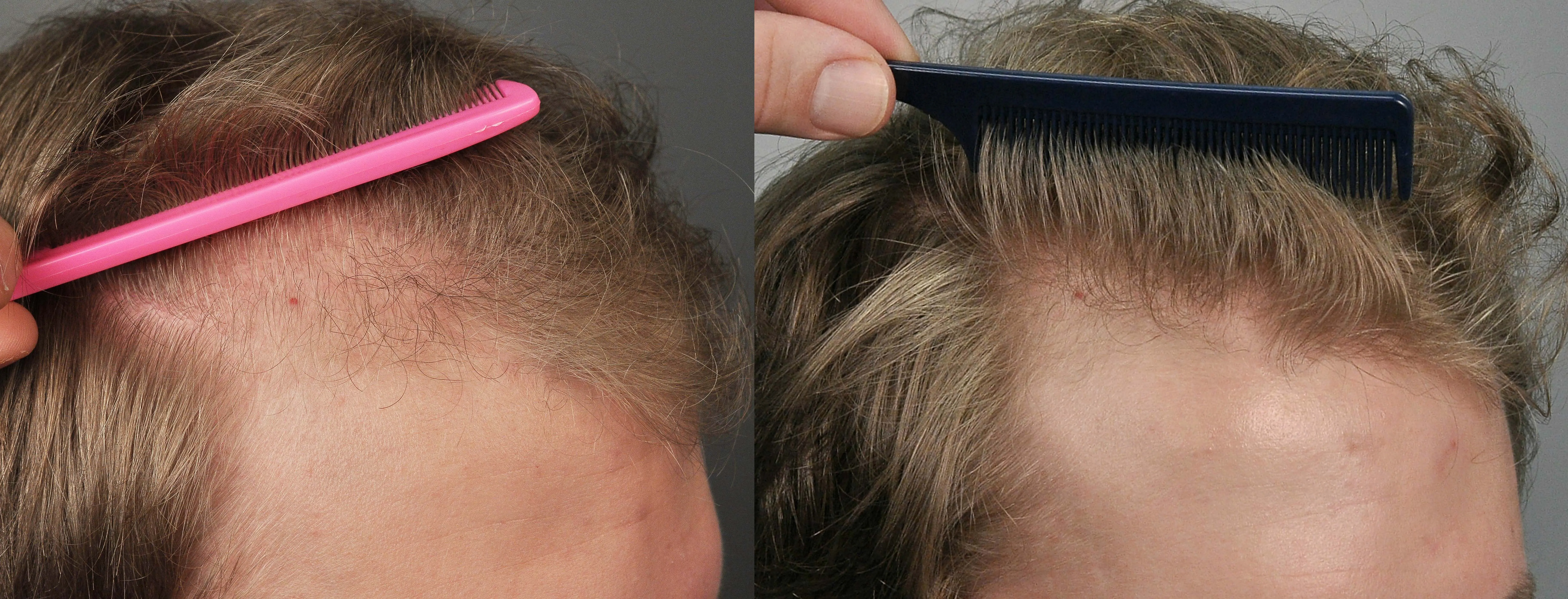 Волосы от висков вдоль щек оставляемые при бритье