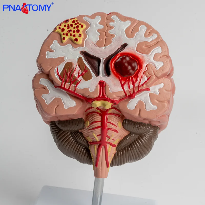 Pvc Brain PVC Brain Anatomical Model Cerebral Hemorrhage and Arteriovenous ...