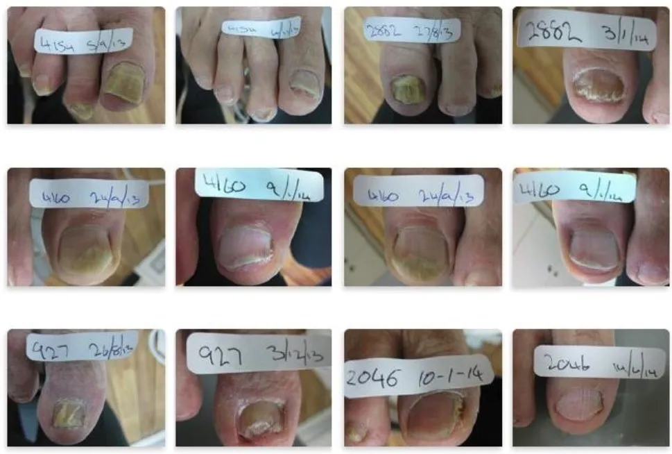 professional fungal nail laser for infection .JPG