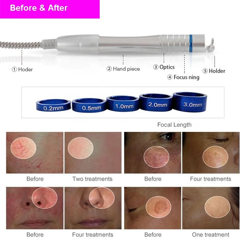 980nm vascular removal before after 1.jpg