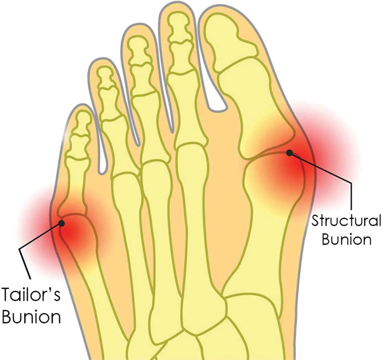 망치 발가락 통증 Bunion 교정기와 Bunion 릴리프 젤 패드 양말 Orthotics 소매 큰 발가락 버팀대 쿠션