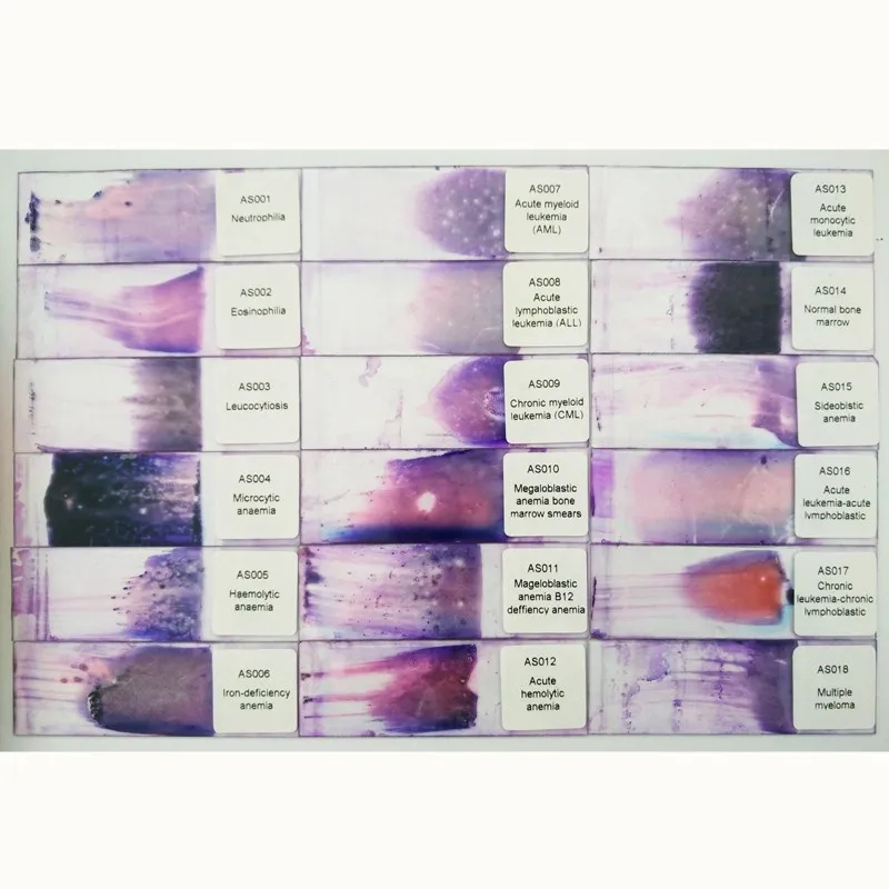 Blood Human Pathology Slides Hematology Pathology Smear Prepared Slides