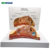 Factory Price Anatomical Female Breast Cross-section Breast Cancer Model