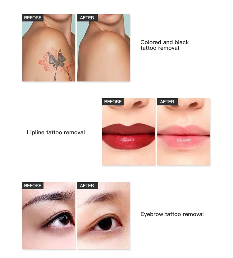 yag laser tattoo (7).jpg