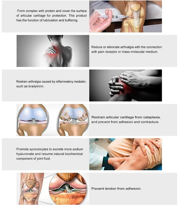 injecții de gel articulare cum este tratată artrita genunchiului
