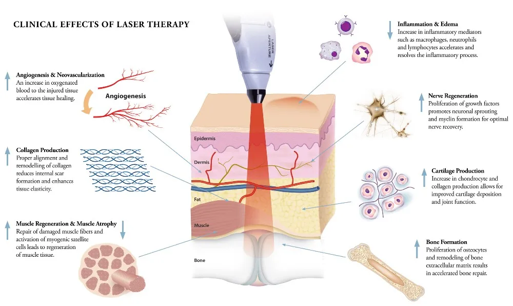 Laser Treatment For Back Pain Side Effects