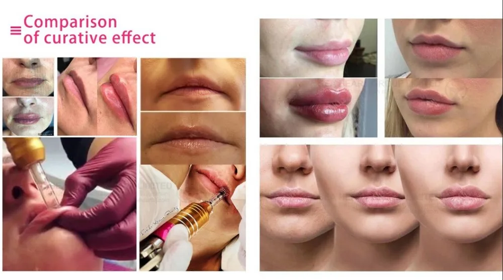 Hyaluron Pen Before After Proper Use Of Hyaluronic Pen Filler Lips In Order To Be Best