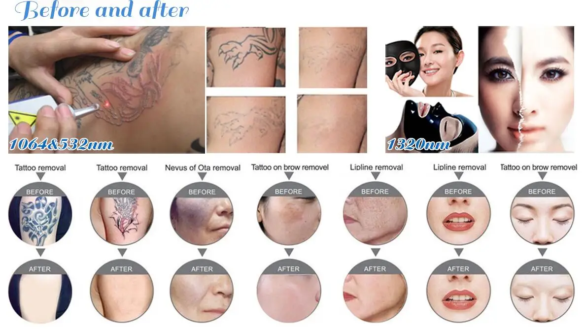 Spot adjustable 1-7mm tattoo removal price nd yag long pulse laser q switch nd yag laser tattoo removal