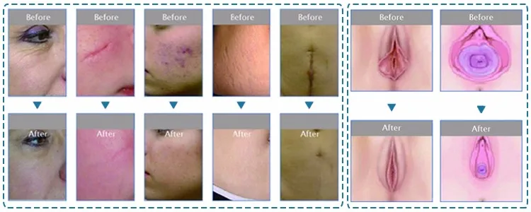 New design Portable Powerful Co2 Fractional Laser Vaginal Tightening Beauty Equipment for Sale