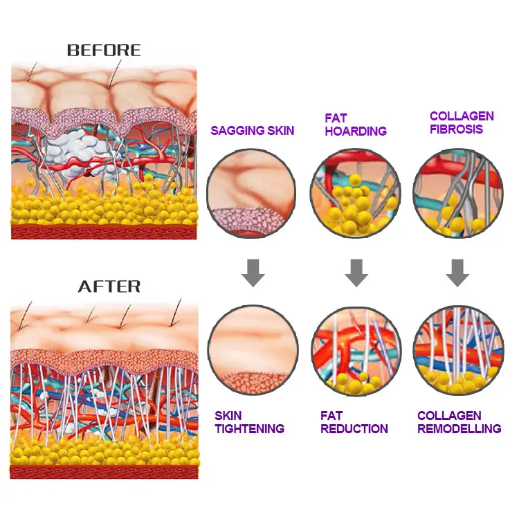 shock wave work principle.jpg
