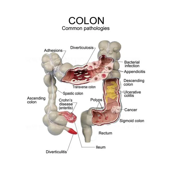 Wonderbaar Pathologie Colon Model Organen Menselijk Lichaam Anatomie - Buy KA-22