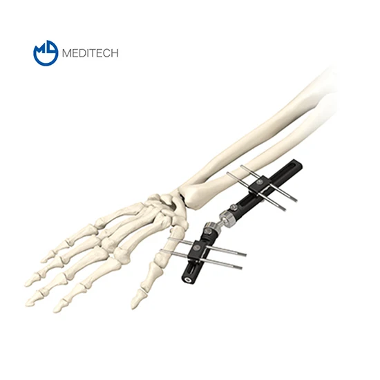 Bone Lengthening External Fixator Orthopedic External Fixation - Buy ...