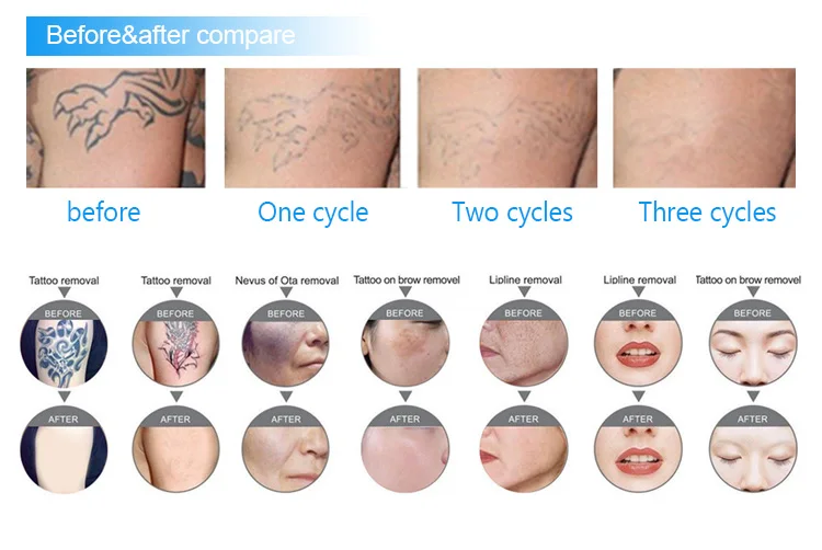 Laser hair removal and tattoos   Urbana