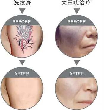 Treatment-Effect-Figures-for-Tattoo-and-Birthmark-Removal-Laser-Tattoo-Removal-Machines-