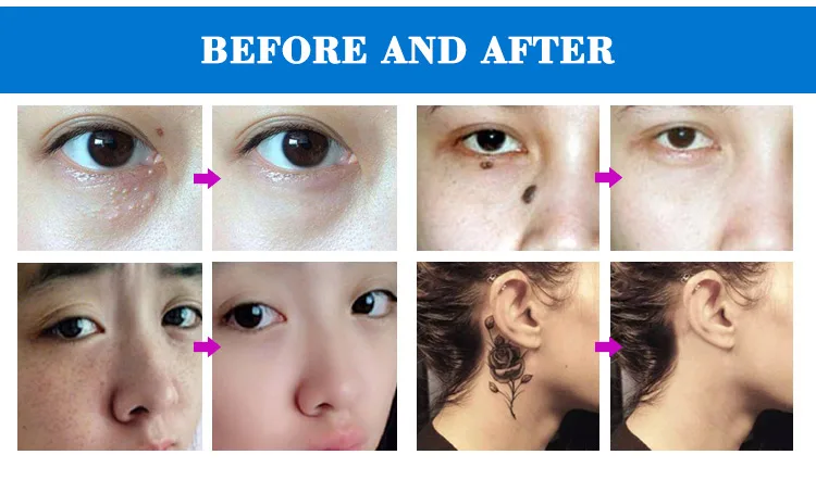Factory wholesale OEM Mole removal plasma beauty pen