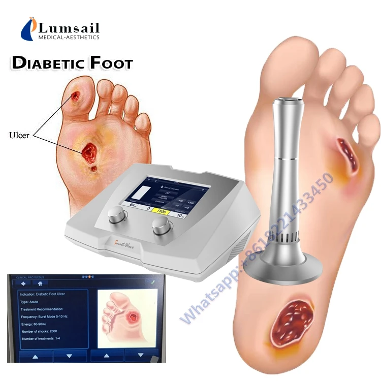 Diabetic Foot Care Eswt Wound Healing Extractorporeal Shockwave Therapy For Diabetic Foot Ulcers