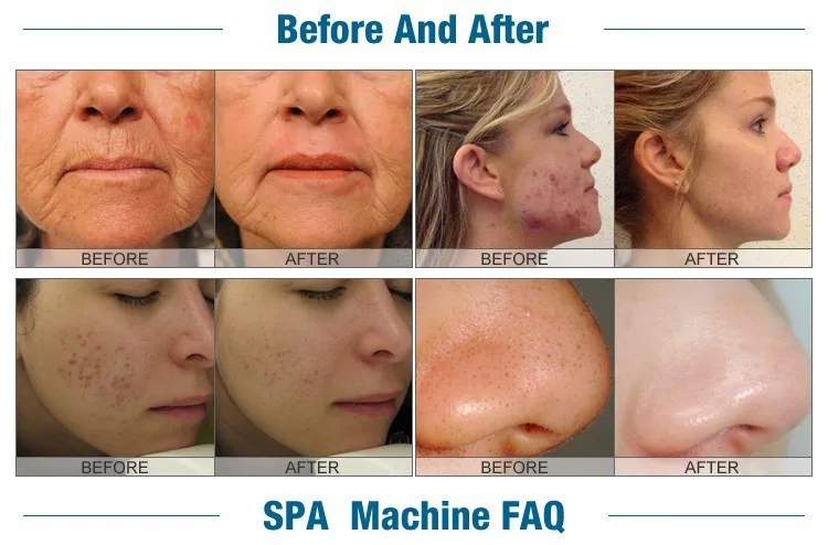 Best MicroDermabrasion Facial Treatment in Pittsburgh Esspa