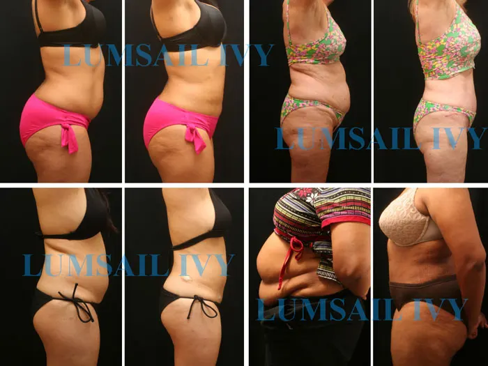 Non Surgical Liposuction Body Shaping Machine