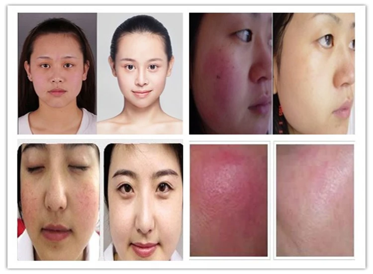 Factory price laser diode 980nm spider vein removal Blood vessel laser vein removal vascular machine