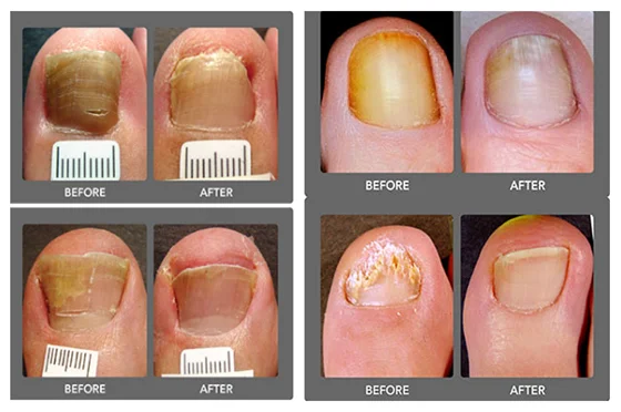 Toe nail laser machine for onychomycosis infection treatment therapy 