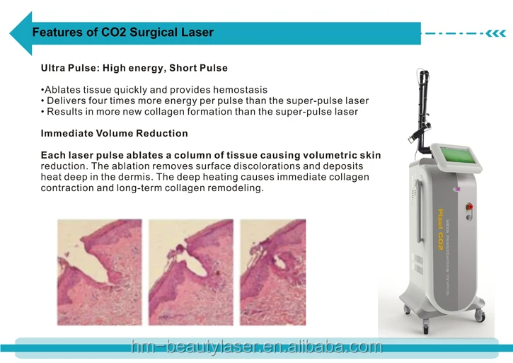 Age Spots Treatment Vaginal Tightening Medical Fractional Co2 Laser/co2