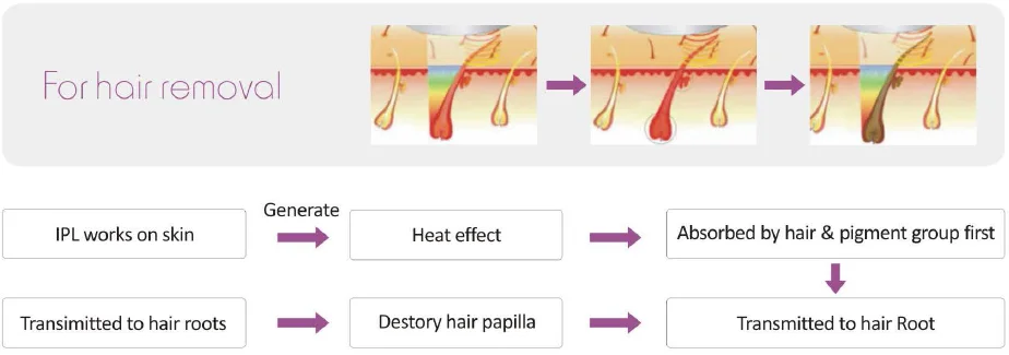 hair removal