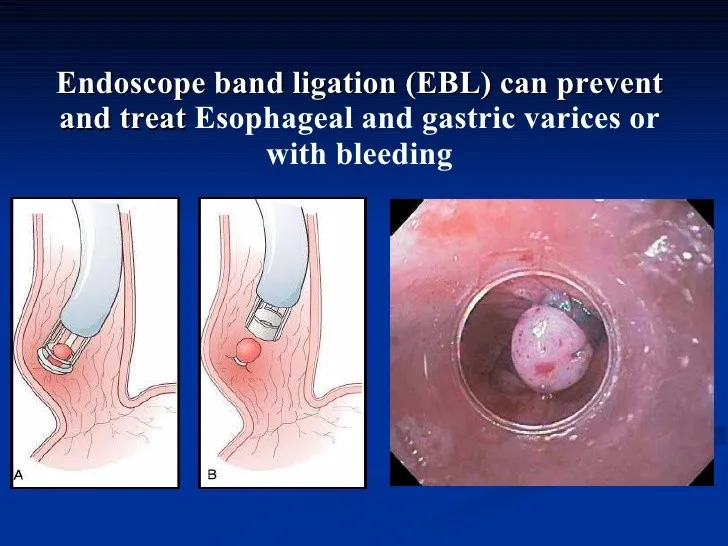 Esophageal Varices Banding