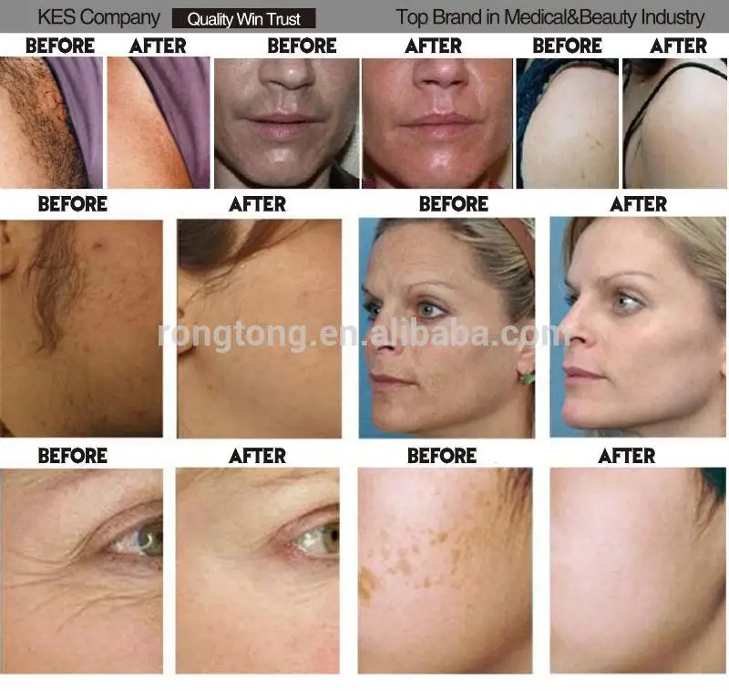 ssr skin rejuvenation shr rf ipl laser hair remove kes beauty shr ssr kes