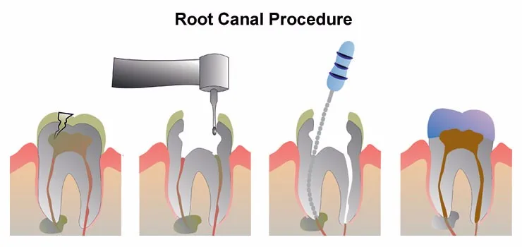 Rogin Dental Niti Rotary Files Sup-taper Gold With Heat Activation And ...