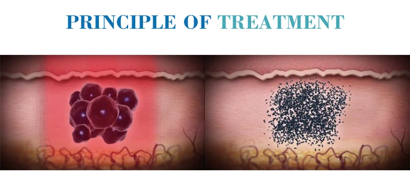 1064nm 532nm Q-switch Picosure Nd Yag Laser For Tattoo Removal