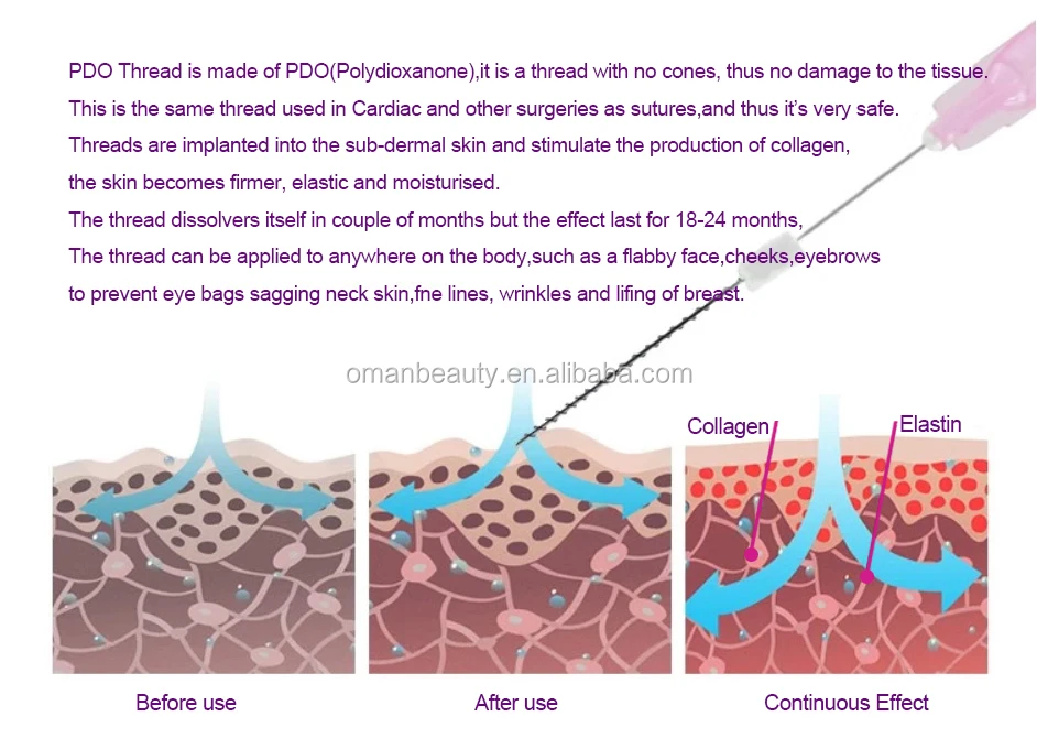 polydioxanone thread lifting.jpg
