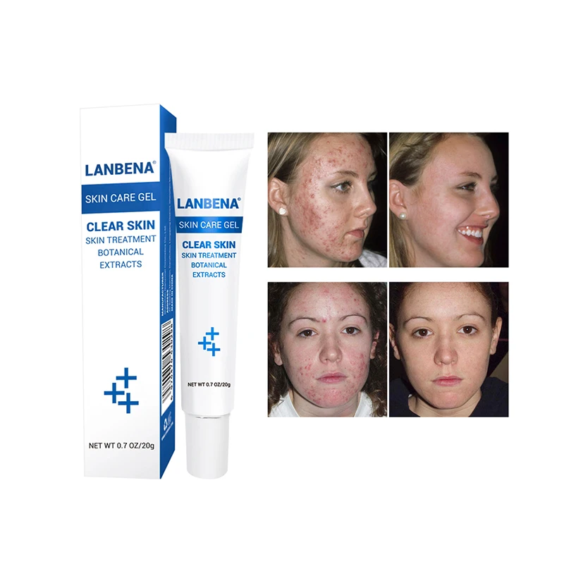 Lanbena Acne Treatment Cream Anti Acne Gel Wholesale - Buy Acne Cream