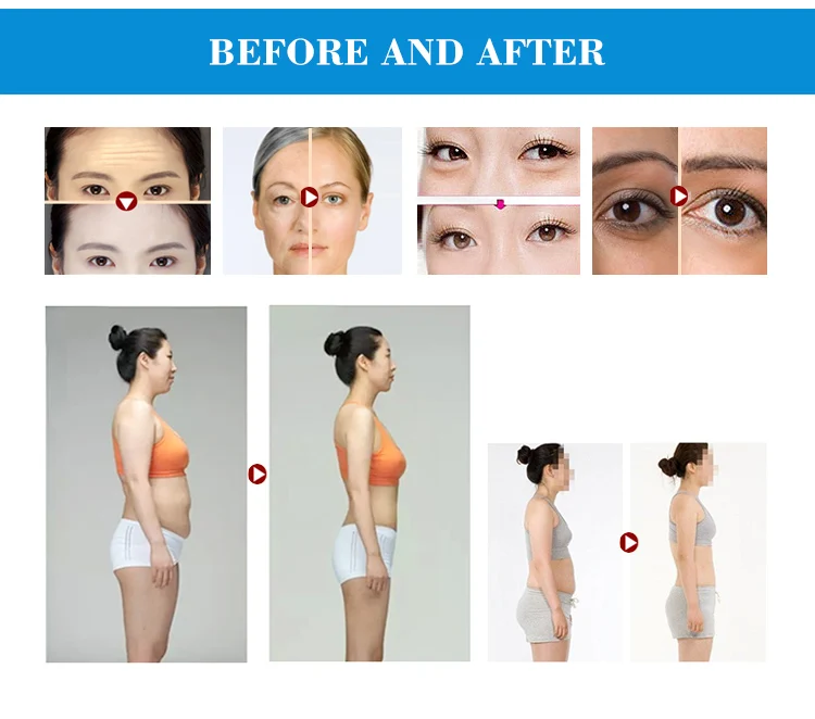 rf slimming machine