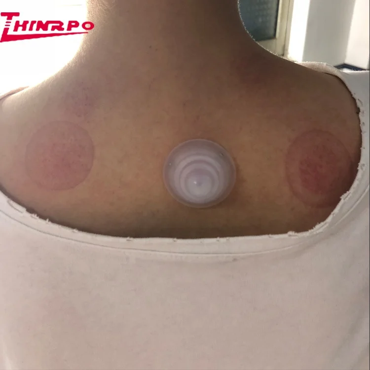 massage cupping.jpg